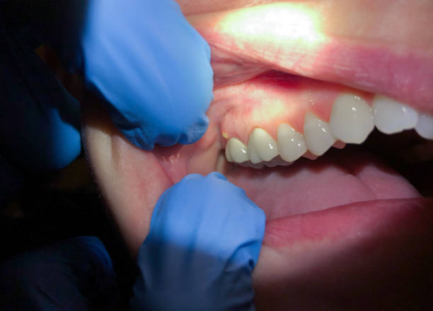Best Emergency Treatment for Dental Infections or Abscesses in Lower Burrell, PA